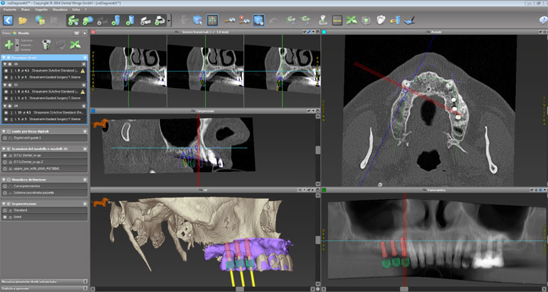 implantologia guidata computerizzata